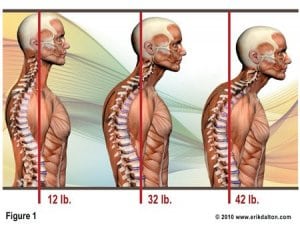 forward-head-posture